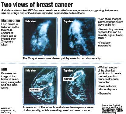 Breast Cancer: Signs, Symptoms, and Prevention